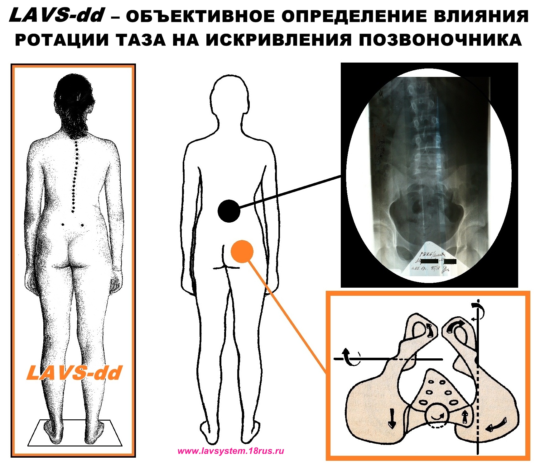 Перекос таза картинки